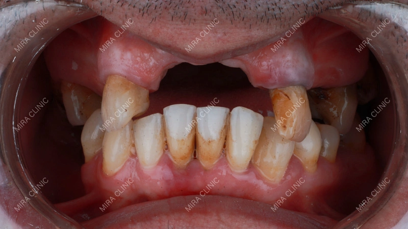 Missing Teeth